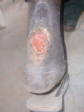 Ulcer on leg.