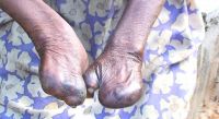 Leprosy at Ogoja.