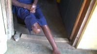 Leprosy disability at Ogoja.